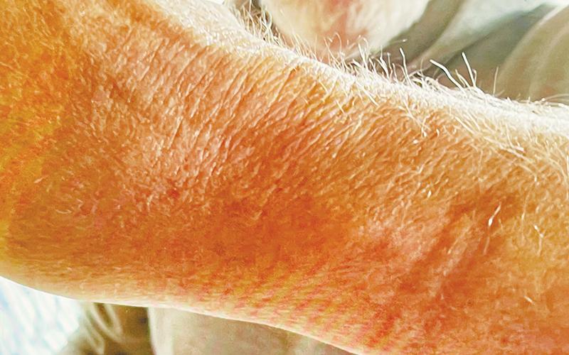 Gerry Laschober took a picture of marks left on his wrist after being handcuffed in March 2017. Photo courtesy of Gerry Laschober