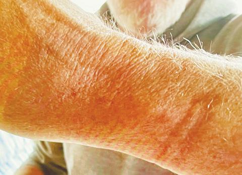 Gerry Laschober took a picture of marks left on his wrist after being handcuffed in March 2017. Photo courtesy of Gerry Laschober